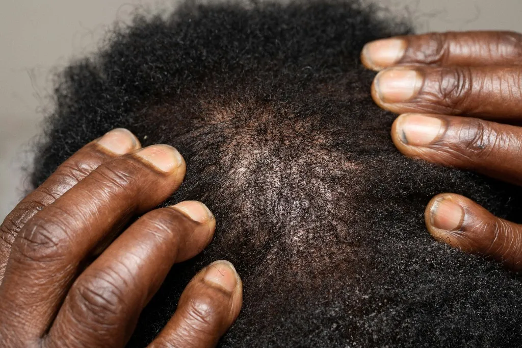 Manos abriendo el cabello sobre una zona con poca densidad.