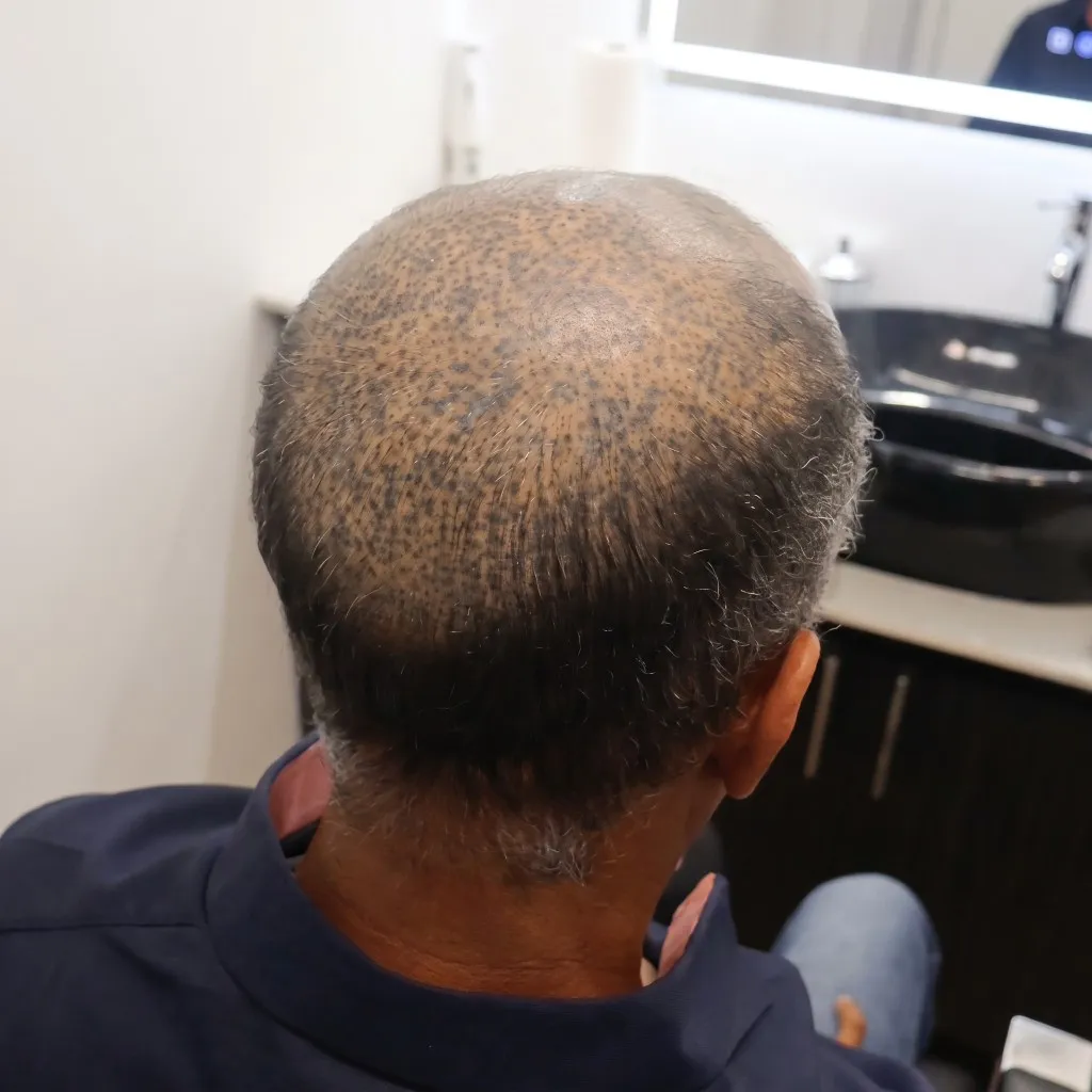 Nuca con canas y cuero cabelludo visible antes del Sistema CTR, y con cabello entrecano y denso después.