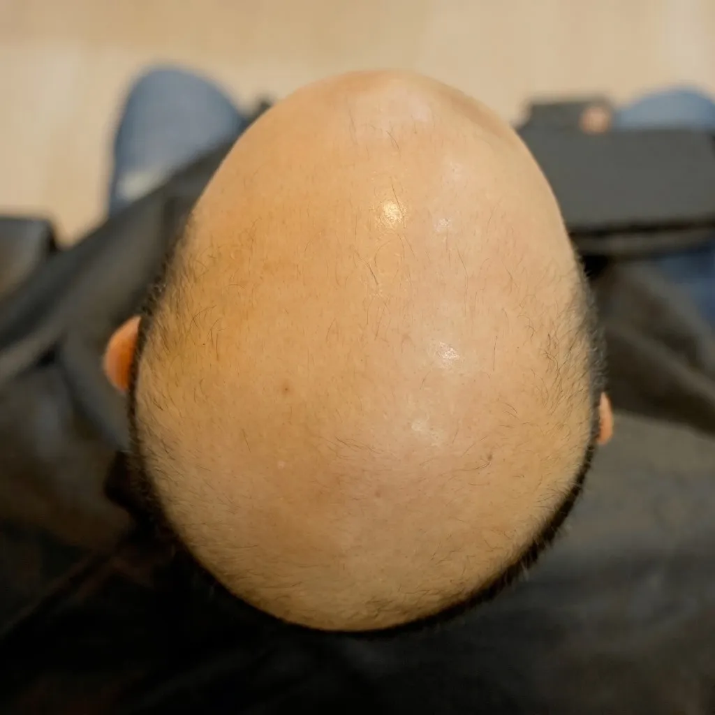 Cabeza vista desde arriba, sin cabello antes del Sistema CTR y con cabello oscuro y lleno después.